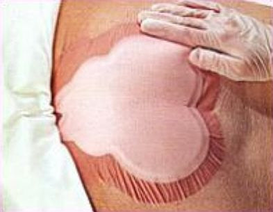 Allevyn Hydrocellular Foam Dressing - Sacrum